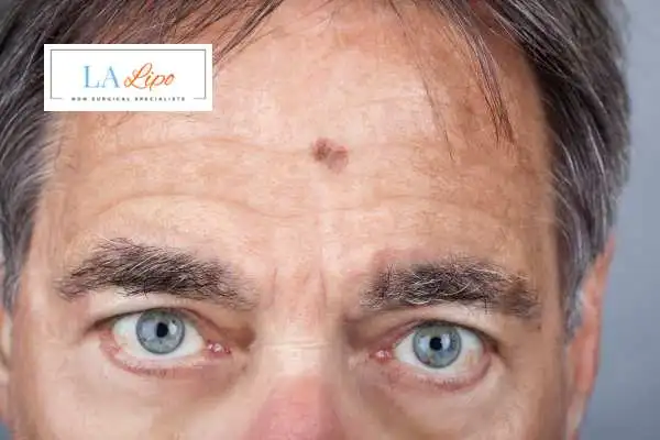Solar Lentigo Removal Sutton image of man with mark on his forehead