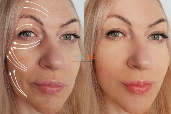 Morpheus 8 results Sutton face lift.