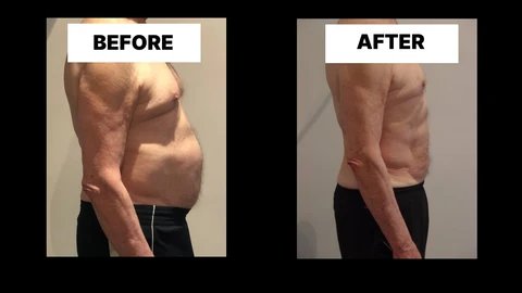 What Symptoms Can Diastasis Recti Cause in Men? Weak Core, Back Pain and Poor Posture Sutton